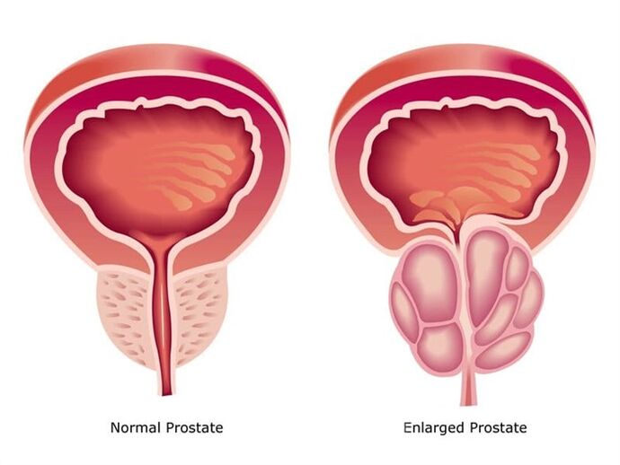 Prostovit normaliséiert d'Aarbecht an d'Gréisst vun der Prostata