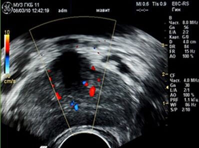 Ultraschall huet Foci vun der Entzündung an der Prostata gewisen