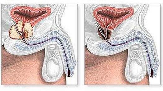 Virun an no der Behandlung vu chronescher Prostatitis chirurgesch