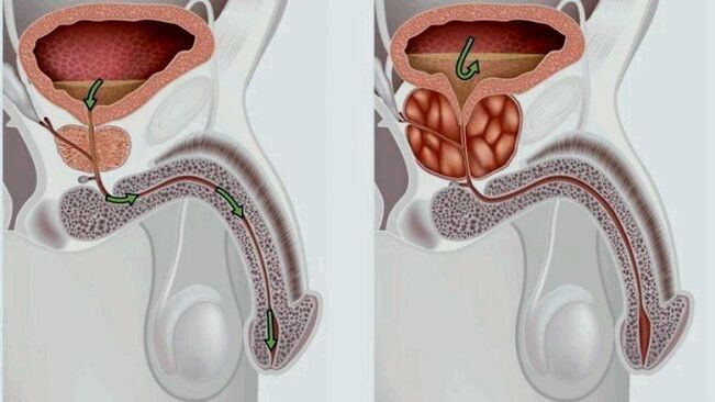 gesond an entzündete Prostata mat Prostatitis