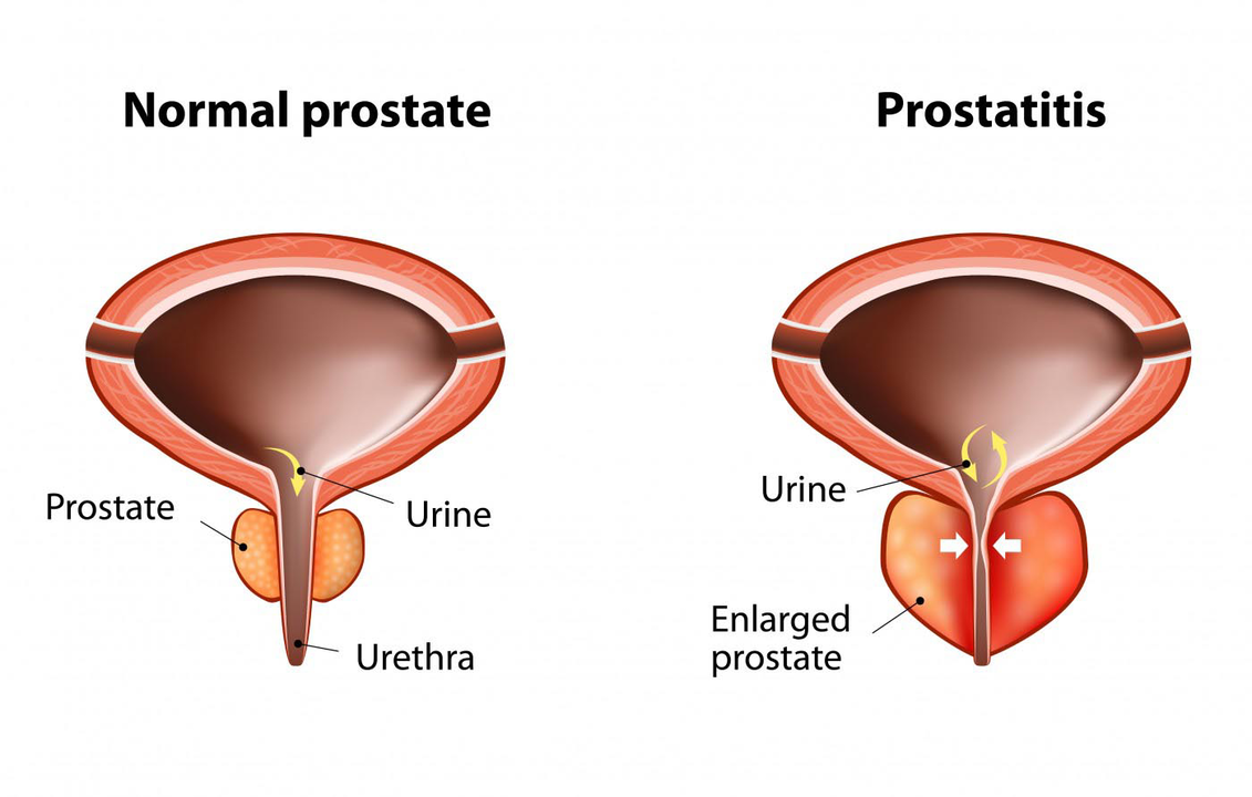 Normal Prostata vun engem gesonde Mann an Entzündung vun der Prostata mat Prostatitis