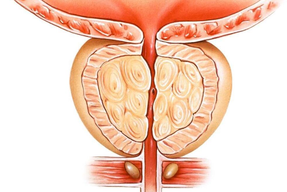 congestive prostatitis