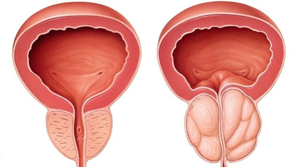 normal a vergréissert Prostata