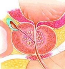 Prostata Adenoma