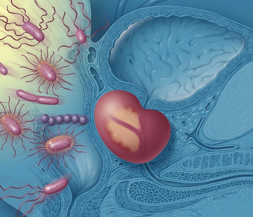 Prostatitis a Männer