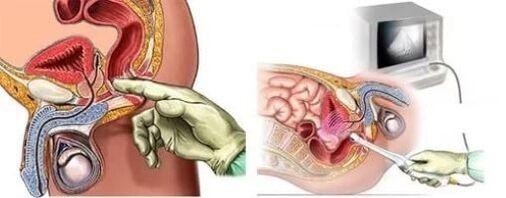 Instrumental Diagnos of Prostatitis