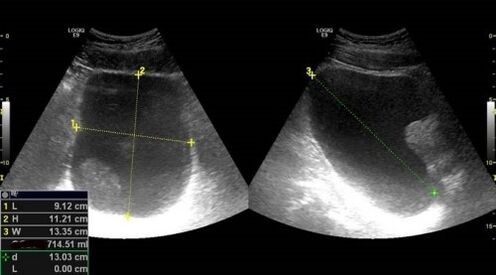 Unzeeche vun Prostatitis fir Ultraschall